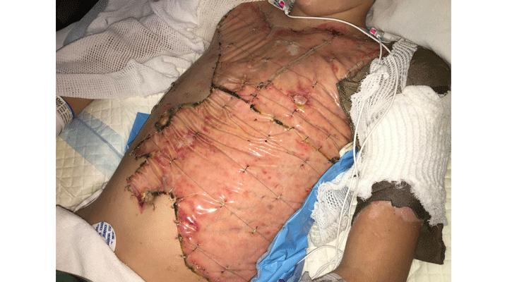Photo showing the skin graft on Conner's chest after his third surgery.