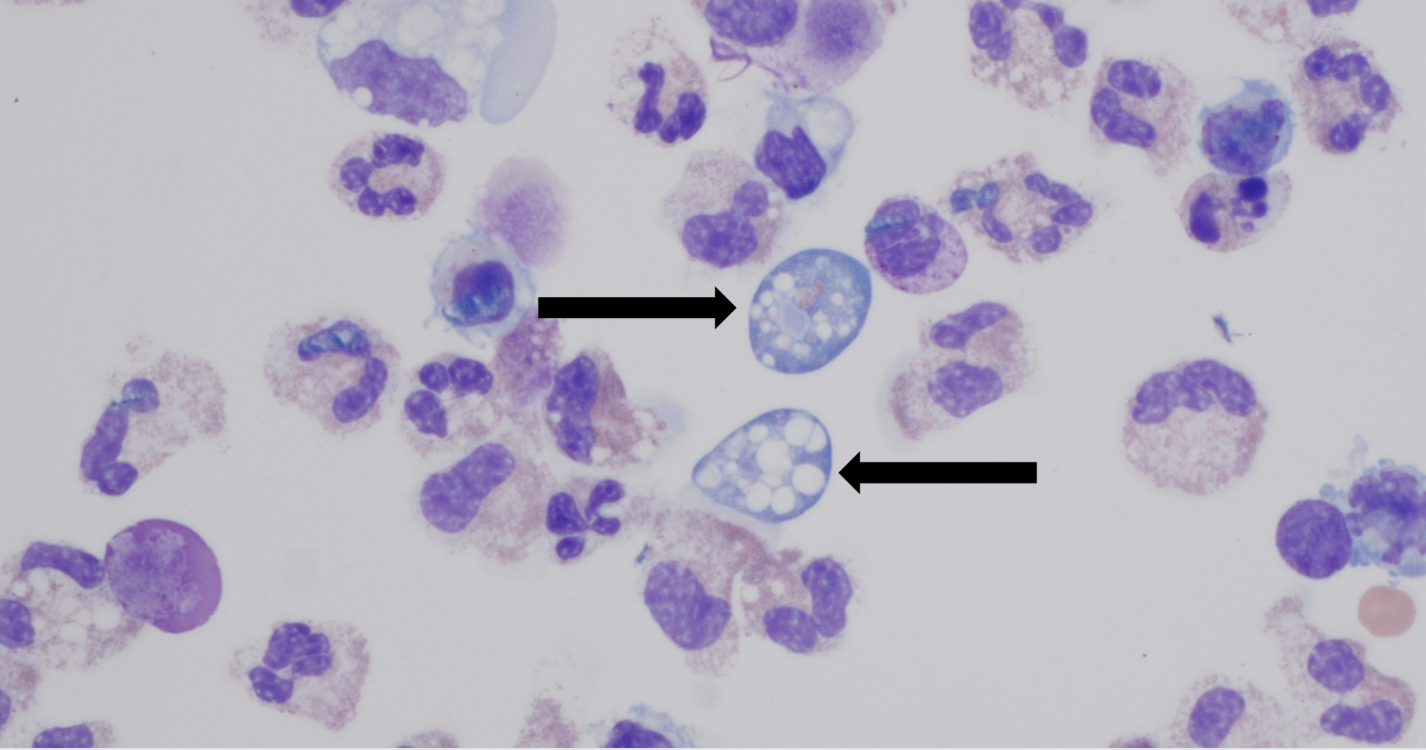Naegleria fowleri infects people by traveling up the nose and to the brain (shown here) where it consumes brain tissue. Photo: Dr. James Roberts, Children’s Healthcare of Atlanta
